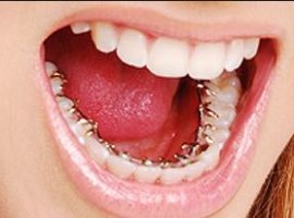 [O que é e para que serve a Ortodontia Lingual?]