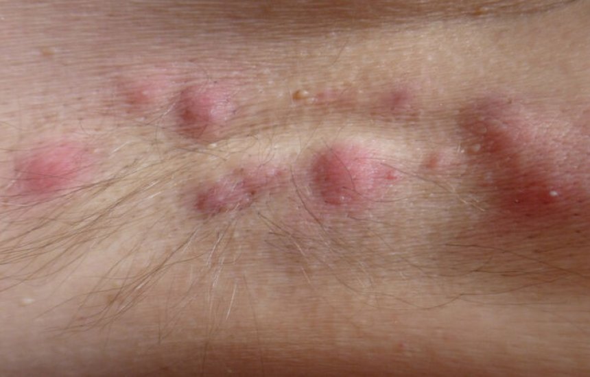 [Hidradenite supurativa: conheça os primeiros sintomas desta doença grave de pele]